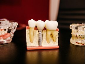 image (dental implants)