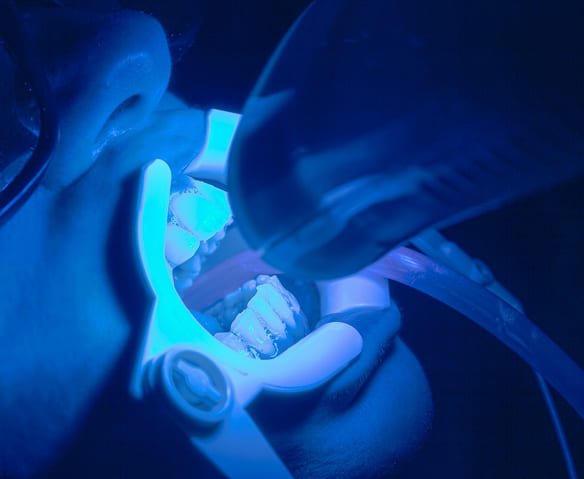 ivoclar blue phase